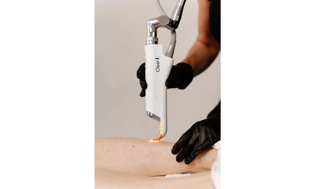 ClearV Laser Targets Visible Veins Beneath The Skin