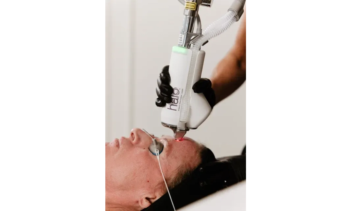 Sciton HALO laser treatment for skin resurfacing